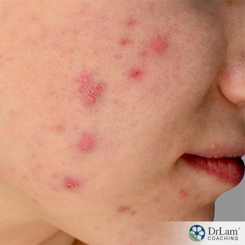 Acne and natural acne solutions