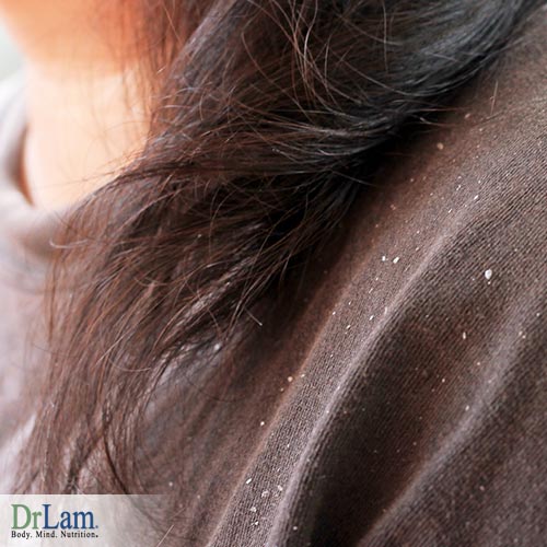 Easy Natural Dandruff Remedies for Healthier Hair and Scalp Today