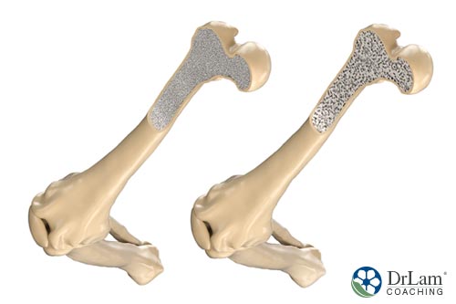 Two brittle bones needing benefits of magnesium to strengthen bone