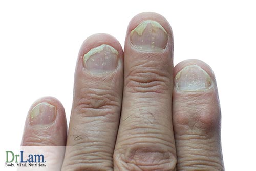 Unhealthy fingernails: Nail Pitting