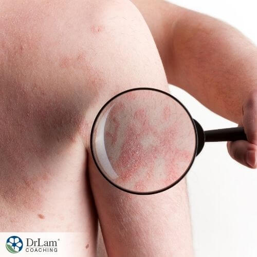 An image of rash all over a person's body