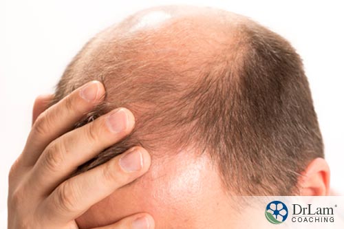 Premature balding is a symptom related to testosterone concerns