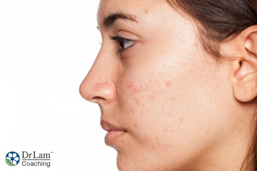 Acne, especially in females, is one of the typical symptoms of adrenal hyperplasia