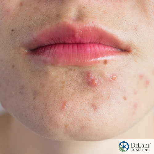 An image of acne on a woman's face