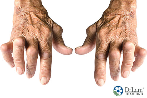image of a hand having arthritis