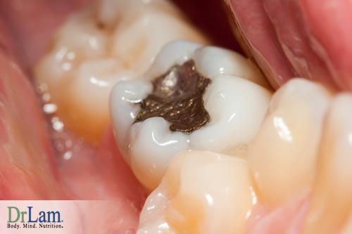 Dental health issues and mercury fillings