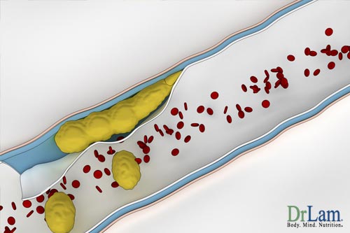 High lipoprotein and atherosclerosis