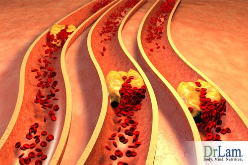 Can heart disease be reversed? Start by reducing atherosclerosis risk.