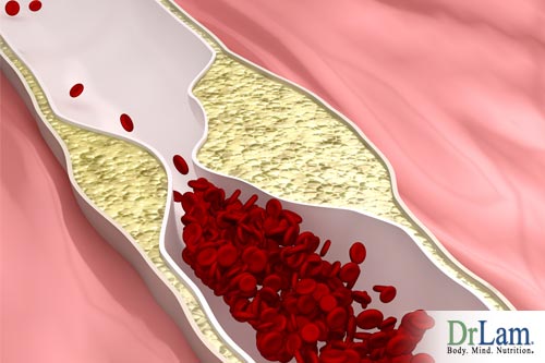 Sugar and aging: Atherosclerosis from sugar not dietary cholesterol