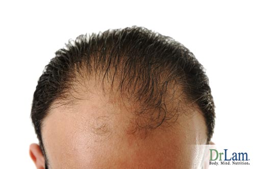 Depending on if your baldness is hormone related, you may be able to change its progression when asking what to take for fatigue/