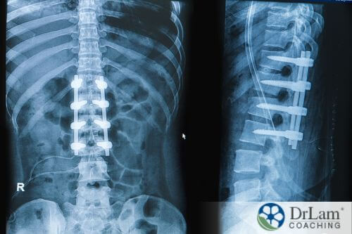 An x-ray showing a spinal fusion
