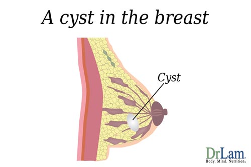 Menopause and fatigue breast cysts
