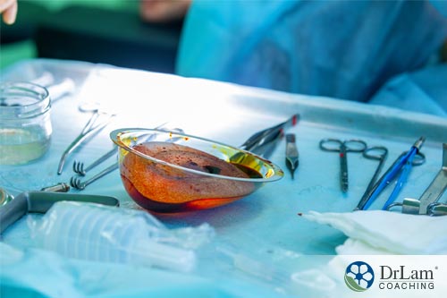 An image of a surgical table with tools ready for breast implant surgery that may result in breast implant illness