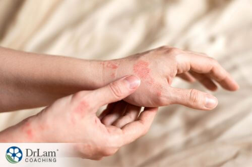 An image of a hand with eczema