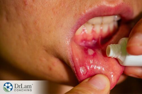 An image of someone applying canker sores ointment 