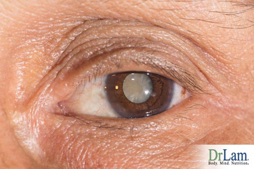 Cancer prevention vitamins and cataracts
