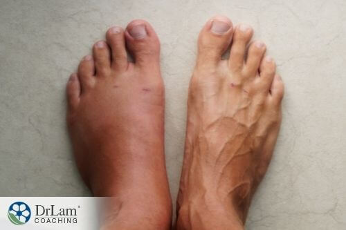 An image of a pair of feet one being very veiny and the other shows signs of swelling