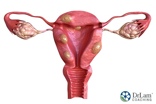 An image of a uterus and ovaries with cancer growth