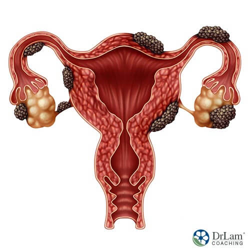 An image of a uterus with endometriosis