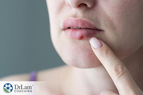 An image of a woman pointing at a cold sore on her mouth