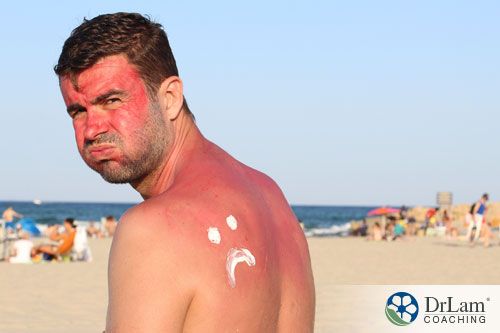 An image of a middle aged man with a sunburn due to overexposure to sunlight