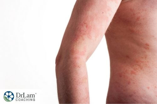 An image of an upper body covered in red rash