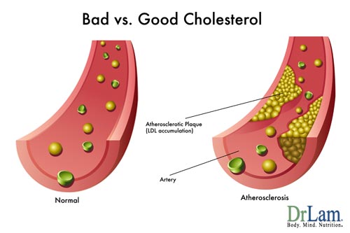 Understanding high cholesterol and good vs bad