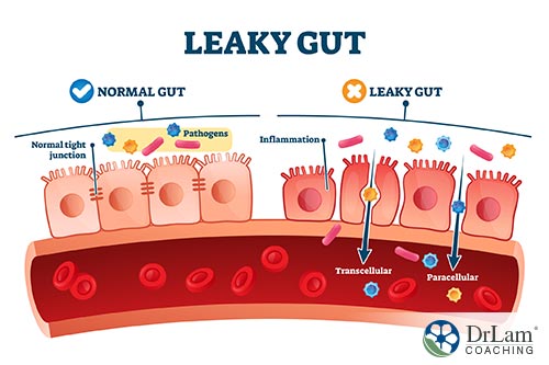 An image of a diagram showing the difference between a leaky gut vs normal gut