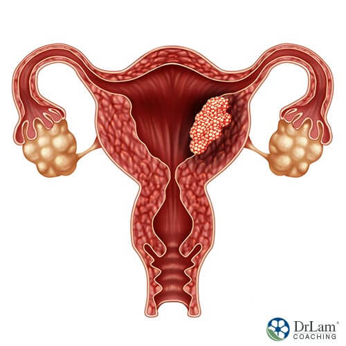 An image of a uterus with a cancer mass