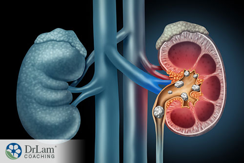An image of kidneys with stones inside