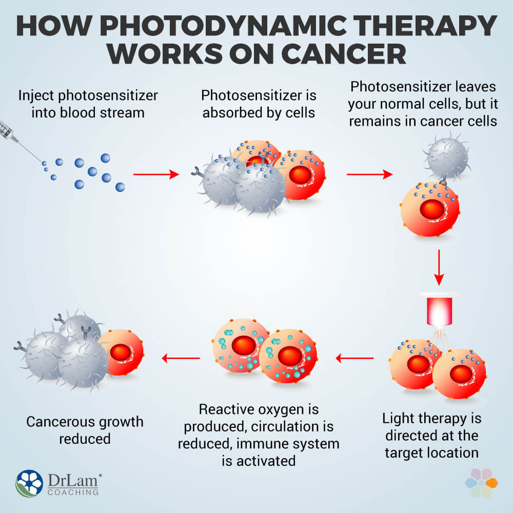 How Photodynamic Therapy Works on Cancer
