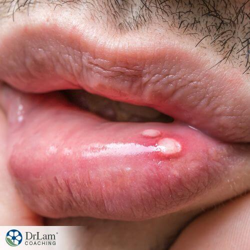 An image of a lips with canker sores