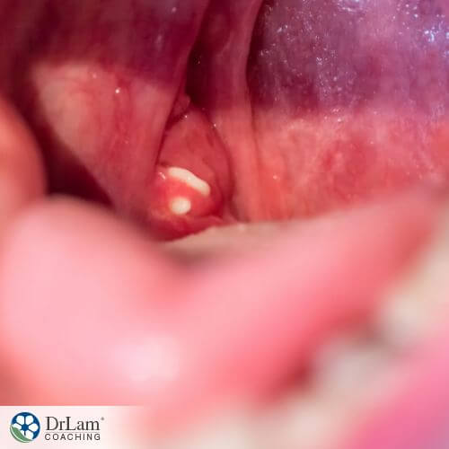 An image of tonsil stones