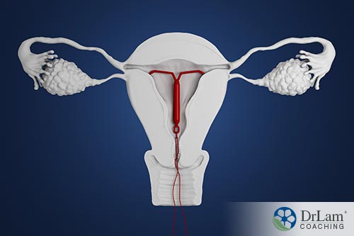 An image of a hormonal IUD