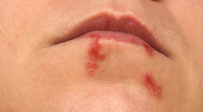 Herpes simplex virus 1 and cold sores