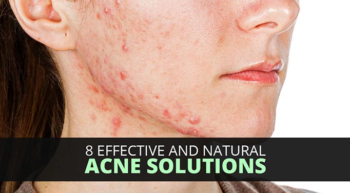 Natural acne solutions