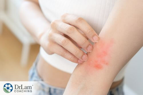 An image of a woman with rashes in the hand