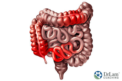 An image of human bowels with areas of inflammation