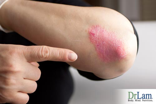 Psoriasis can be due to the inflammation circuit