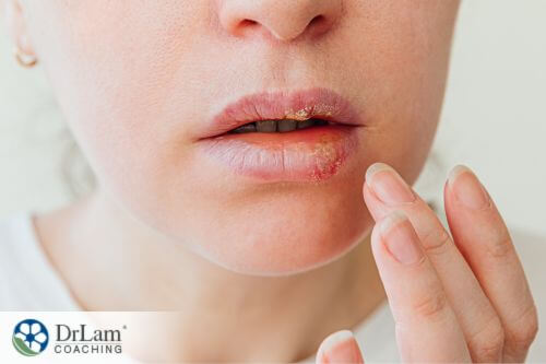 An image of a woman with rashes in her lips