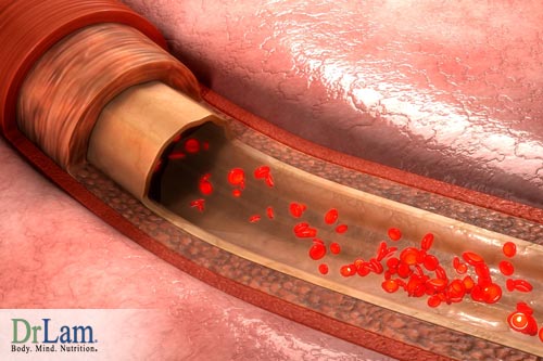 Blood vessel repair and 'Can heart disease be reversed' answers