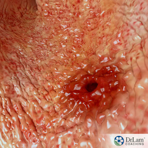 An image of an ulcer