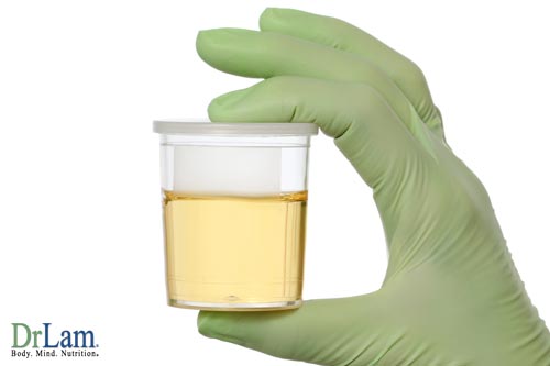 Urine with wasted megadose vitamin C