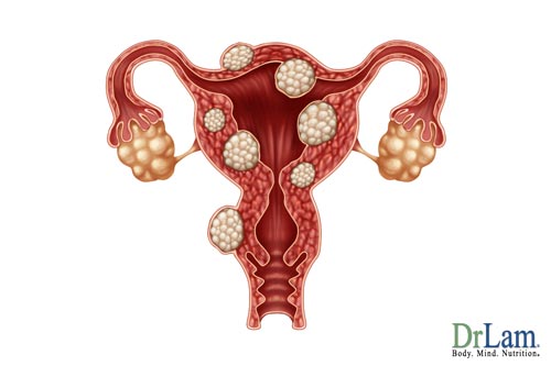 Progesterone cream and uterine fibroids
