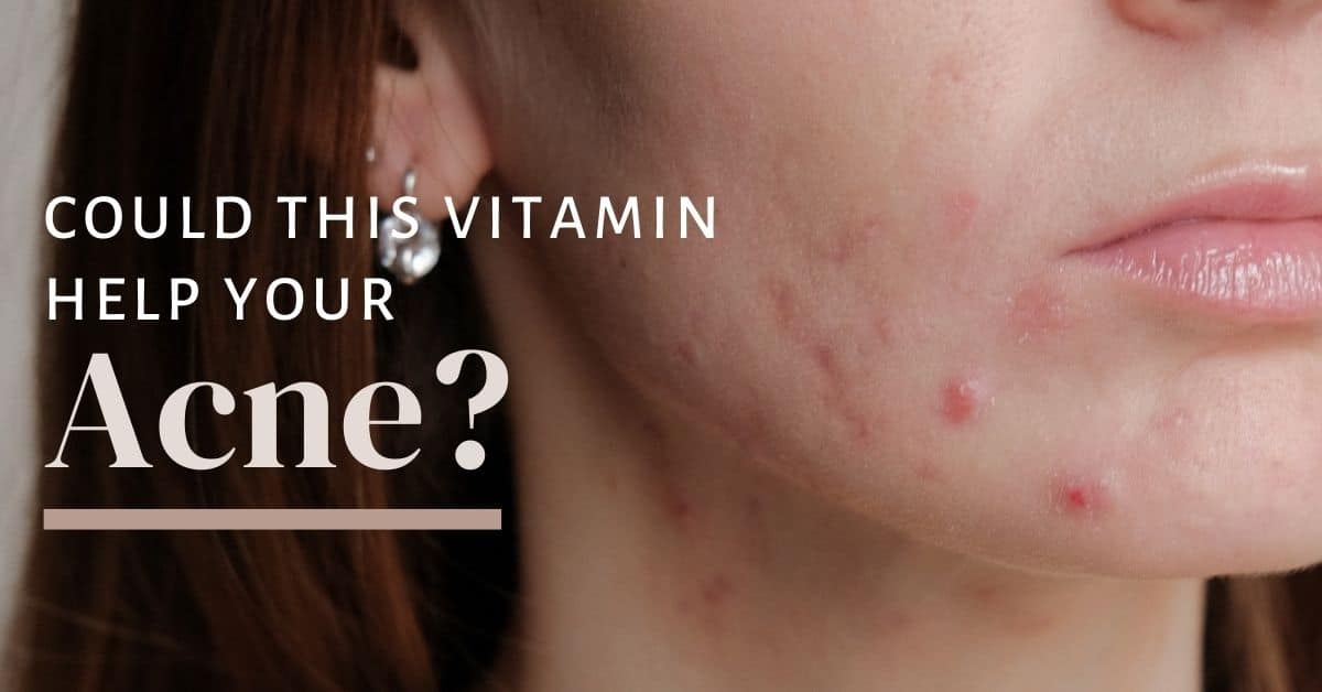 Treating Acne With Vitamin A: A Potential Solution To The Imbalance